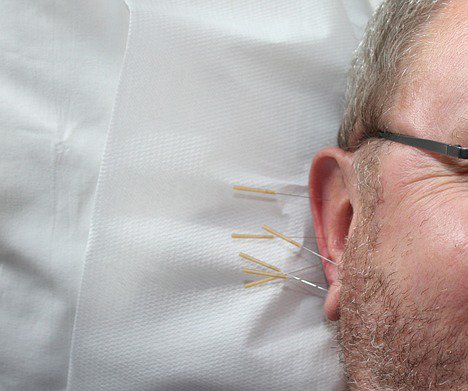 Auriculopuntura Auriculoterapia