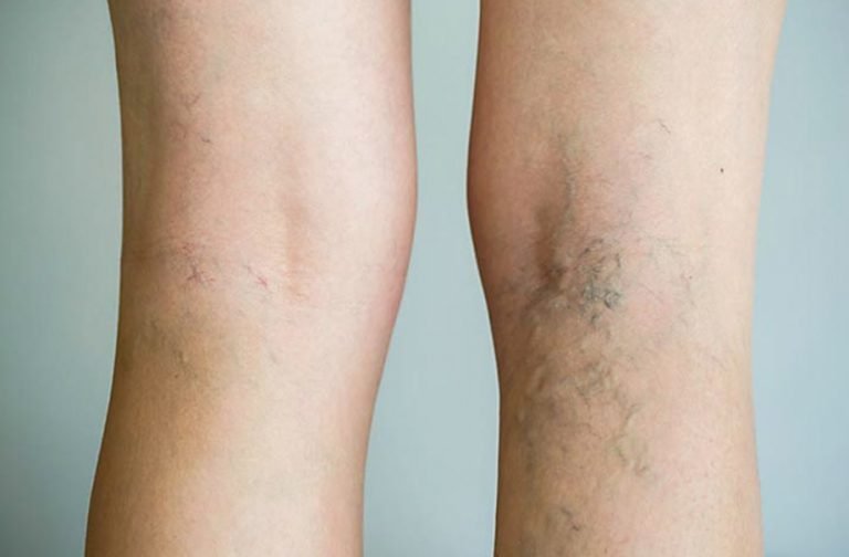 contraindicaciones masaje